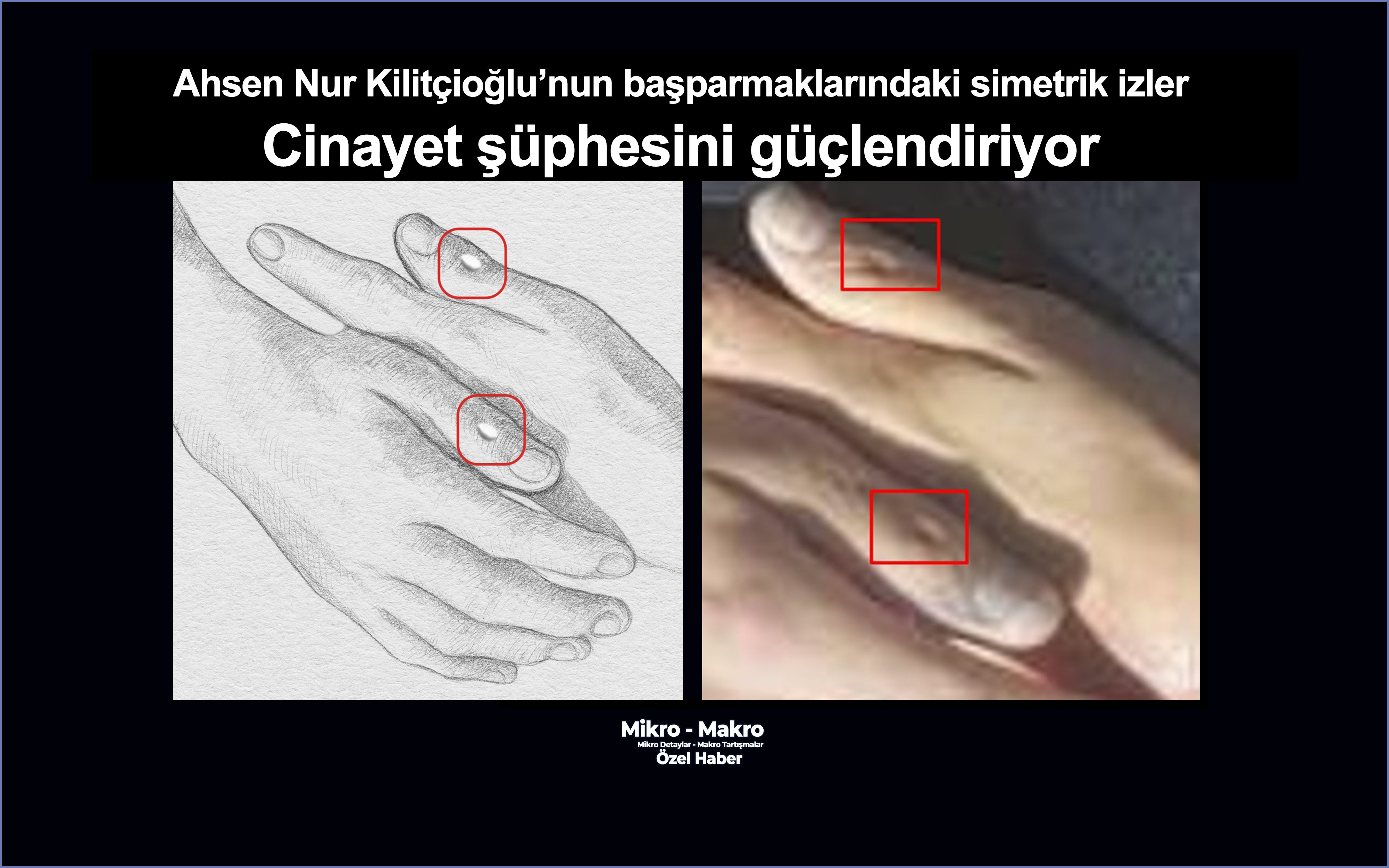 Ahsen Nur Kilitçioğlu’nun iki başparmağındaki simetrik izler cinayet şüphesini güçlendiriyor